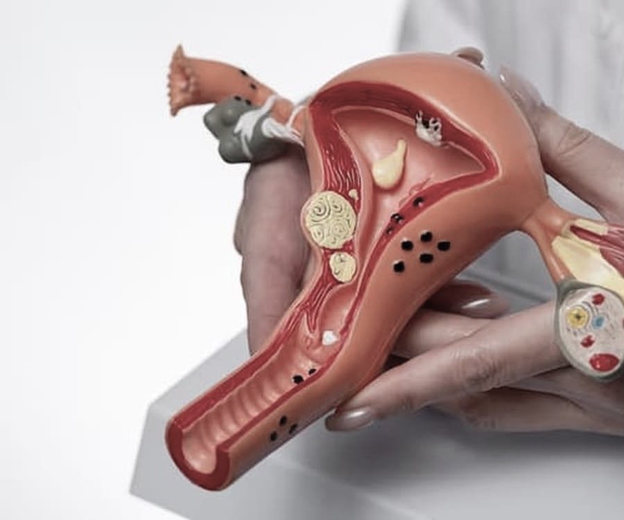 Doenças Ginecológicas Benignas